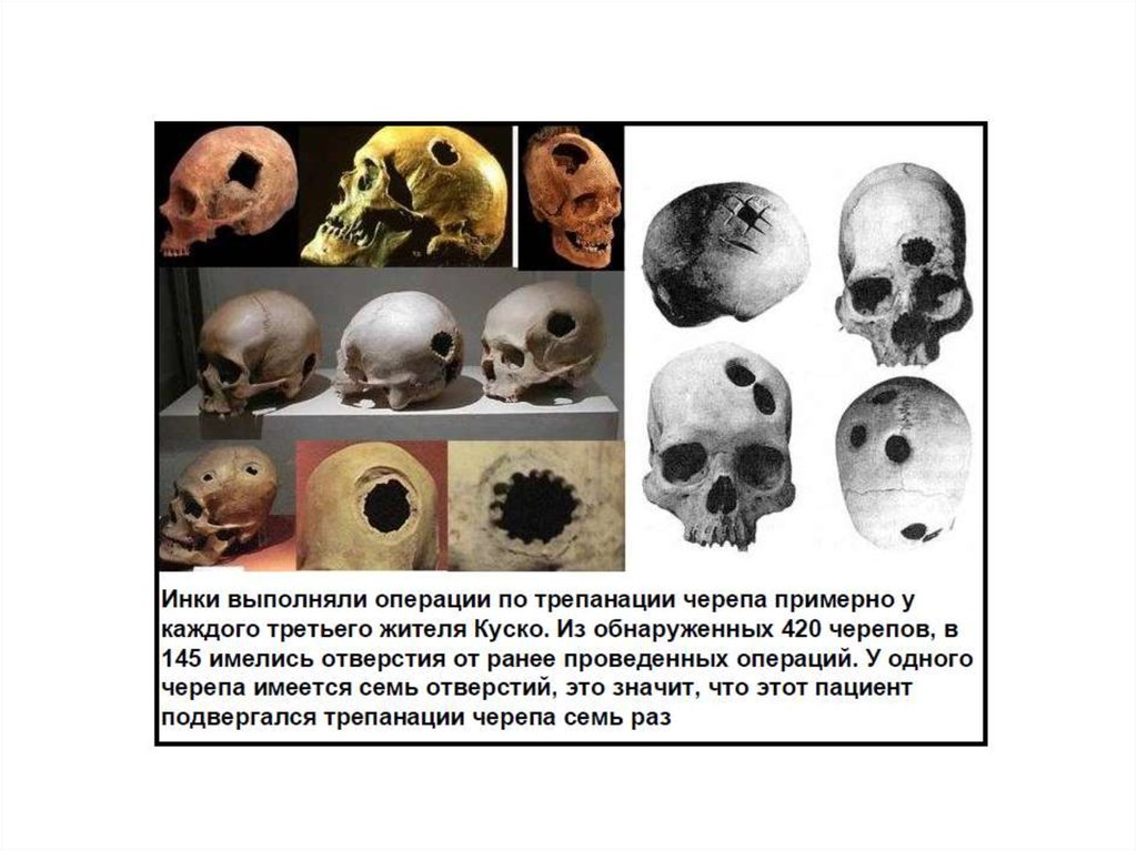 Трепанация черепа презентация