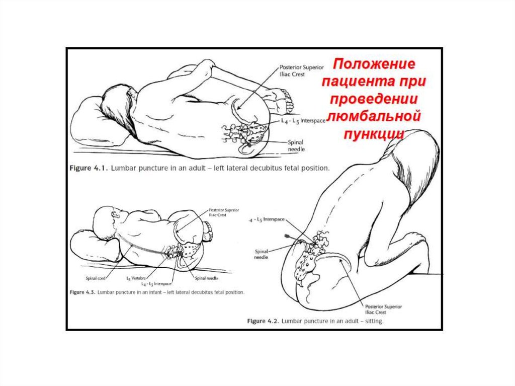 Трепанация черепа презентация