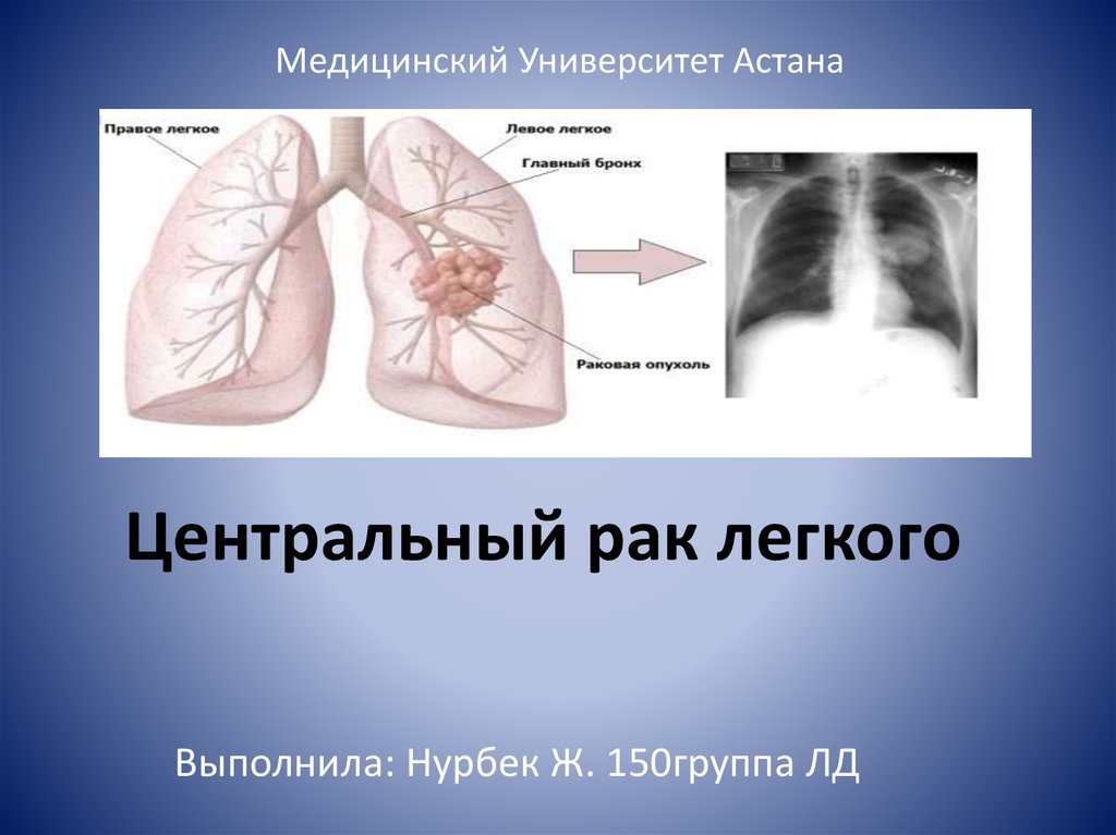 Центральный рак легкого презентация