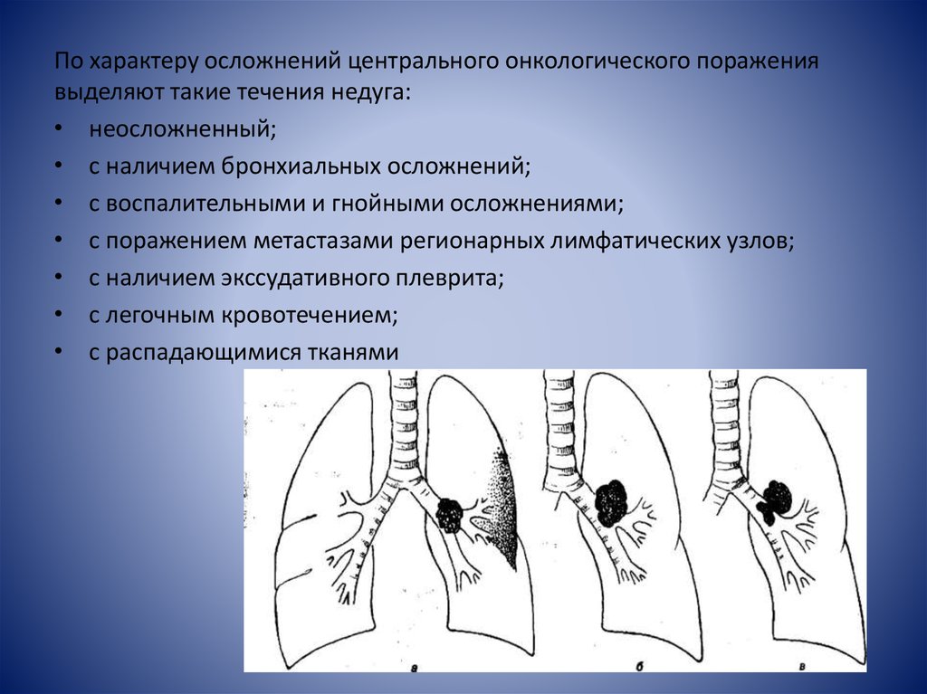 Центральный рак легкого. Малые признаки опухолевого поражения. КЛАССИФИКАЦИЯ%20РАКА%20ЛЕГКИХ%20ПО%20ТНМ%20КАРТИНКА.