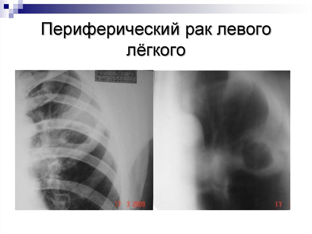 Периферическая легких. Периферический Раковый распад легкого рентген. Периферический тумор левого легкого с централизацией. Синдром перстня на рентгенограмме.