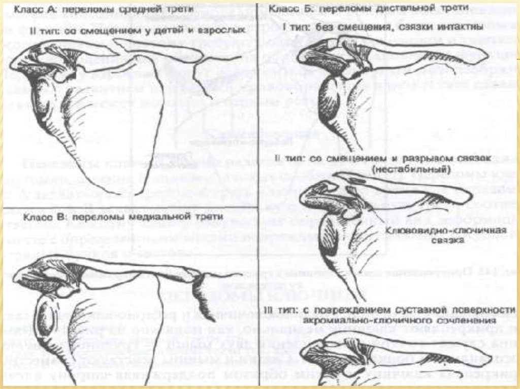 Перелом ключицы карта вызова смп