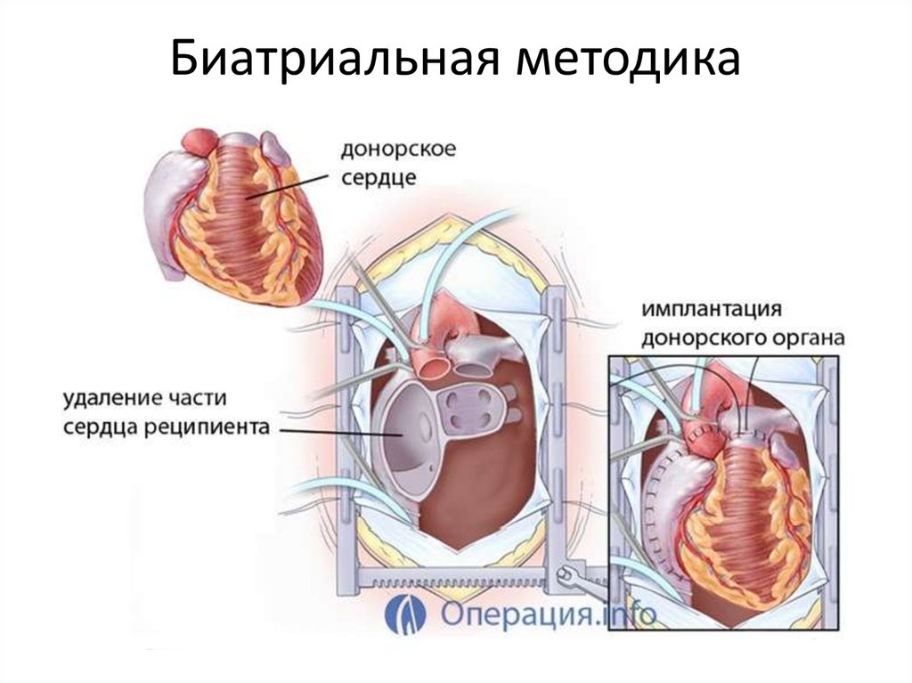 1 донор 2 реципиента. Биатриальная методика пересадки сердца. Техника ортотопической трансплантации сердца. Схема пересадки сердца.