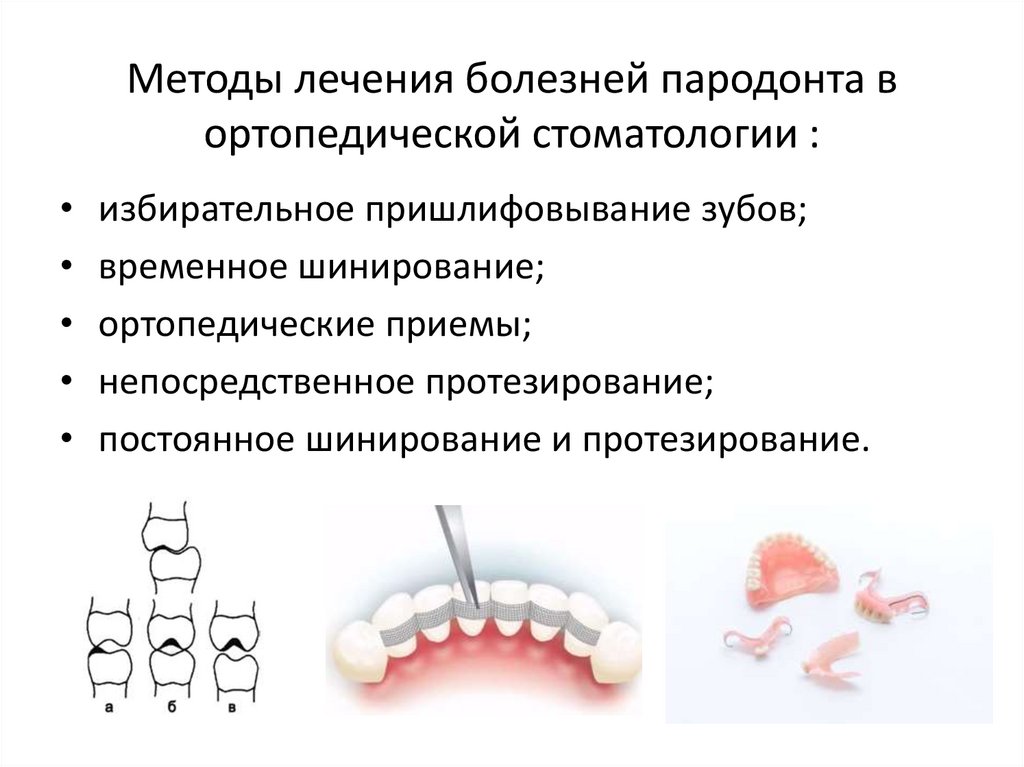 Ортопедический этап лечения. Ортопедические методы лечения пародонта. Шинирование зубов ортопедической стоматологии. Ортопедическое лечение заболеваний пародонта. Комплексная терапия заболеваний пародонта.