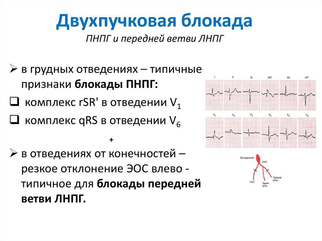 Экг показало блокаду. Блокада ЛНПГ на ЭКГ. Двухпучковая блокада ножек пучка Гиса.