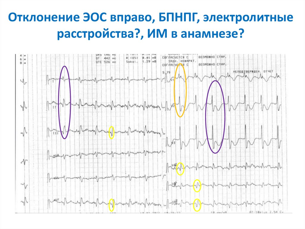 Отклонение электрической оси. ECG электрическая ось вправо. Электрическая ось отклонена вправо ЭКГ. ЭКГ ЭОС отклонена вправо блокада. Отклонение ЭОС вправо на ЭКГ.