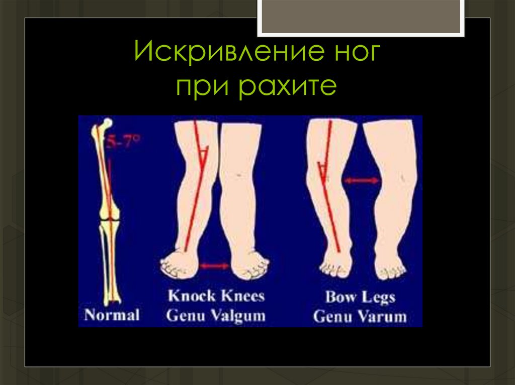 Искривление ног при рахите