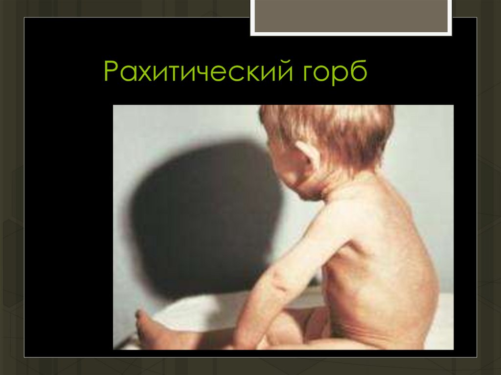 Рахитический горб