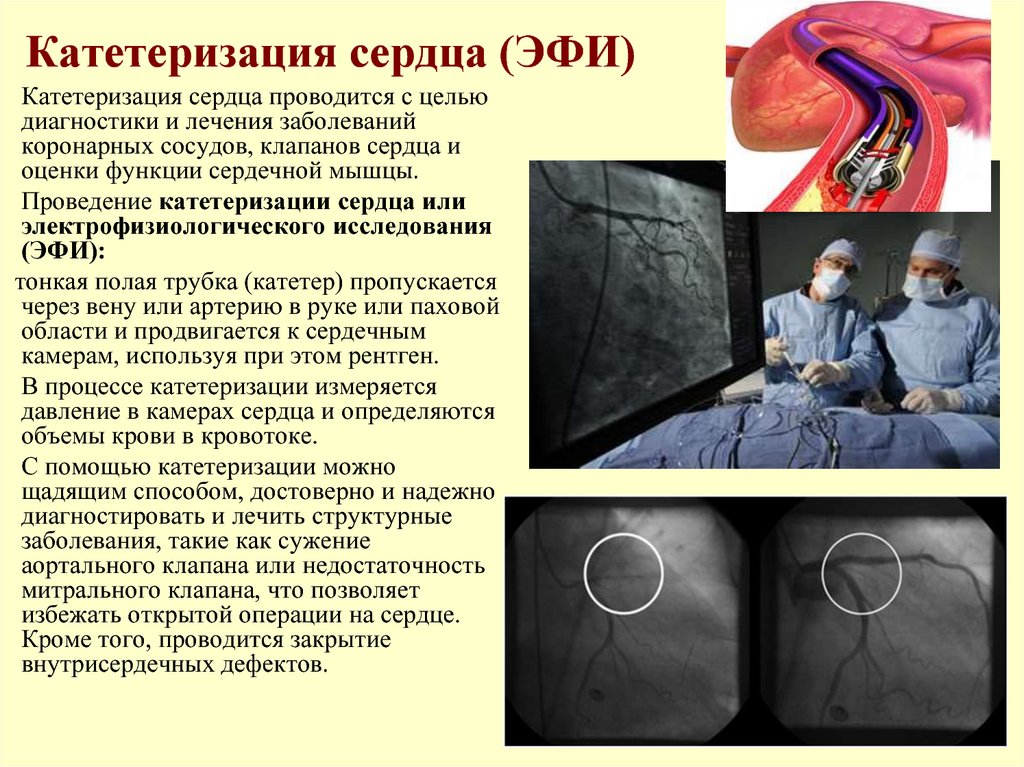 Сердечный через. Катетеризация полостей сердца методика. Катетеризация правых отделов сердца. Катетеризация полостей сердца и магистральных сосудов. Катетеризация правых полостей сердца.