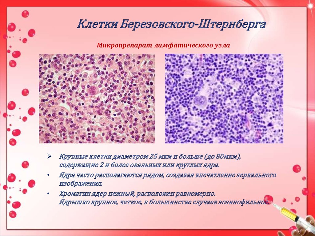 Клетки рида штернберга. Клетки Рид-Березовского-Штернберга. Многоядерные клетки Березовского-Рид-Штернберга. Клетки Березовского Штерн. Морфология клеток Рид-Березовского-Штернберга.