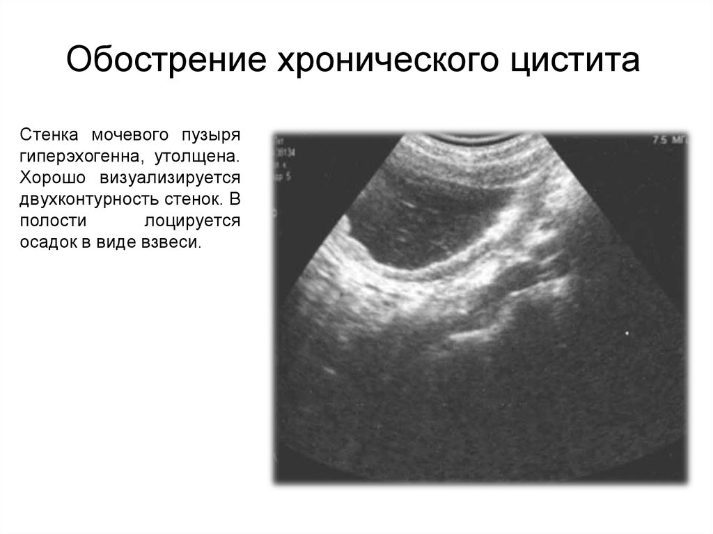 Хронический цистит карта вызова