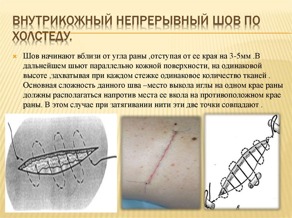 Через сколько дней после операции. Непрерывный внутрикожный косметический шов. Косметический хирургический шов . Техника наложения. Техника наложения косметического шва непрерывного. Внутрикожный Узловой шов.