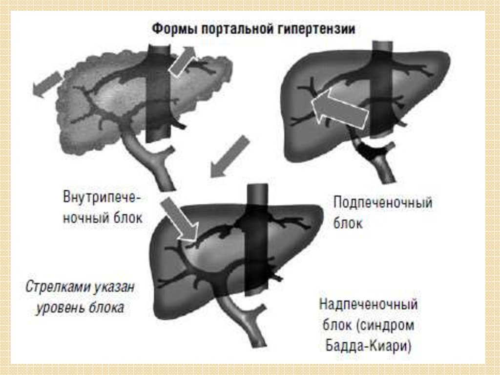 Тромбоз воротной вены печени. Подпеченочная печеночная портальная гипертензия. Классификация подпеченочной портальной гипертензии. Портальная гипертензия подпеченочный блок. Синдром портальной гипертензии классификация.