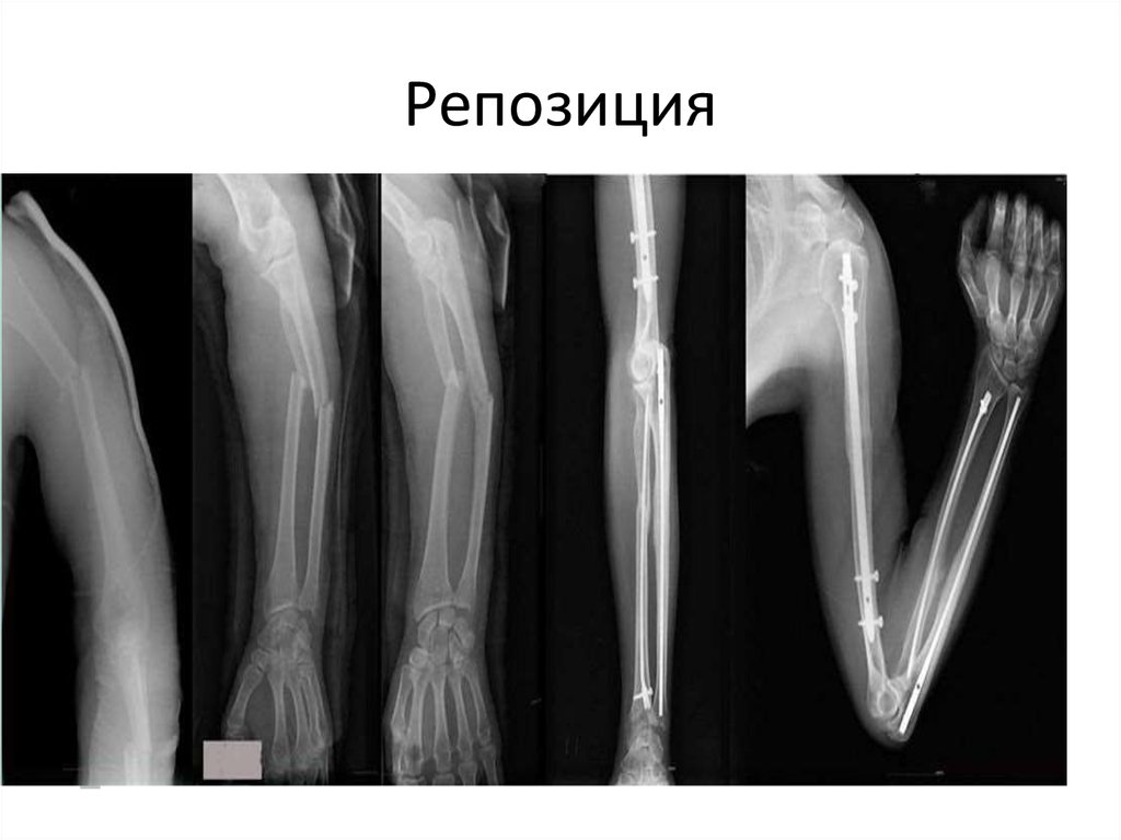 Открытая репозиция костей