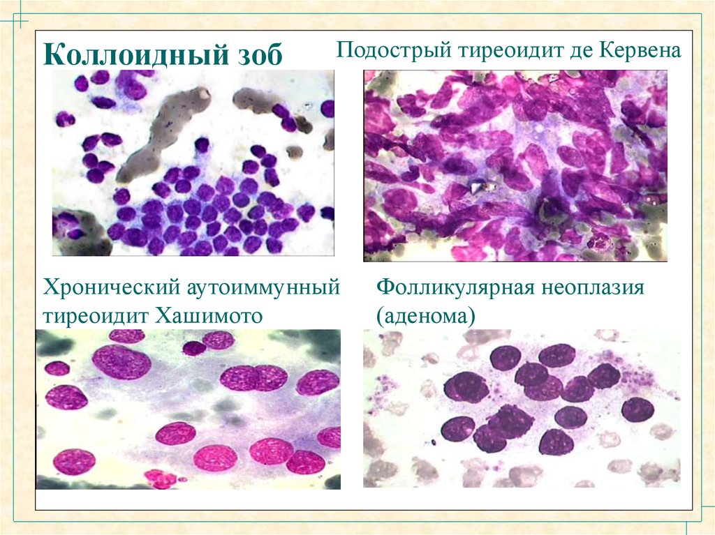 Цитологическая картина коллоидного узла щитовидной железы