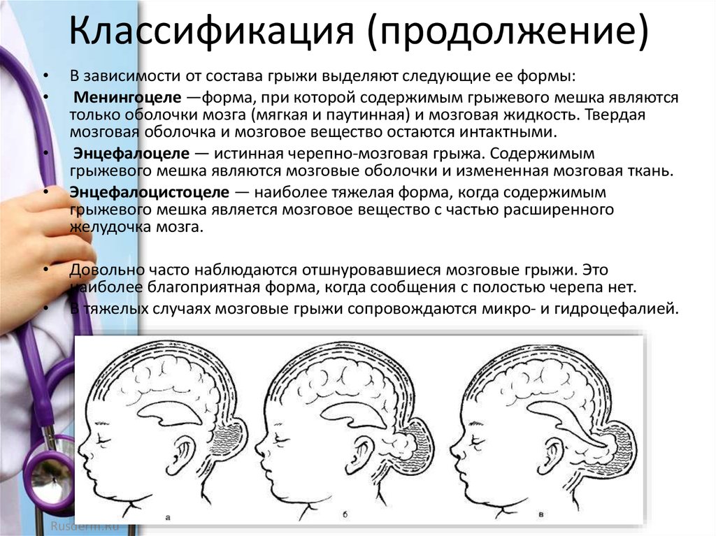 Грыжа мозговых оболочек латынь. Врожденные черепно мозговые грыжи. Врожденная мозговая грыжа. Классификация черепно-мозговых грыж.