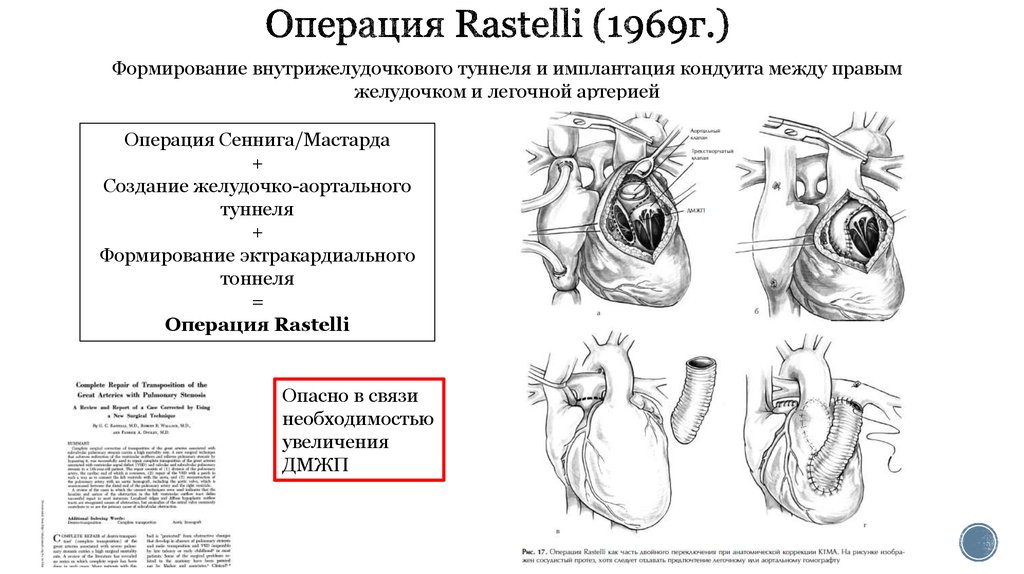 Операция буква. Операция Мастарда и Сеннинга. Операция Растелли при ТМС. Операция при транспозиции магистральных сосудов.