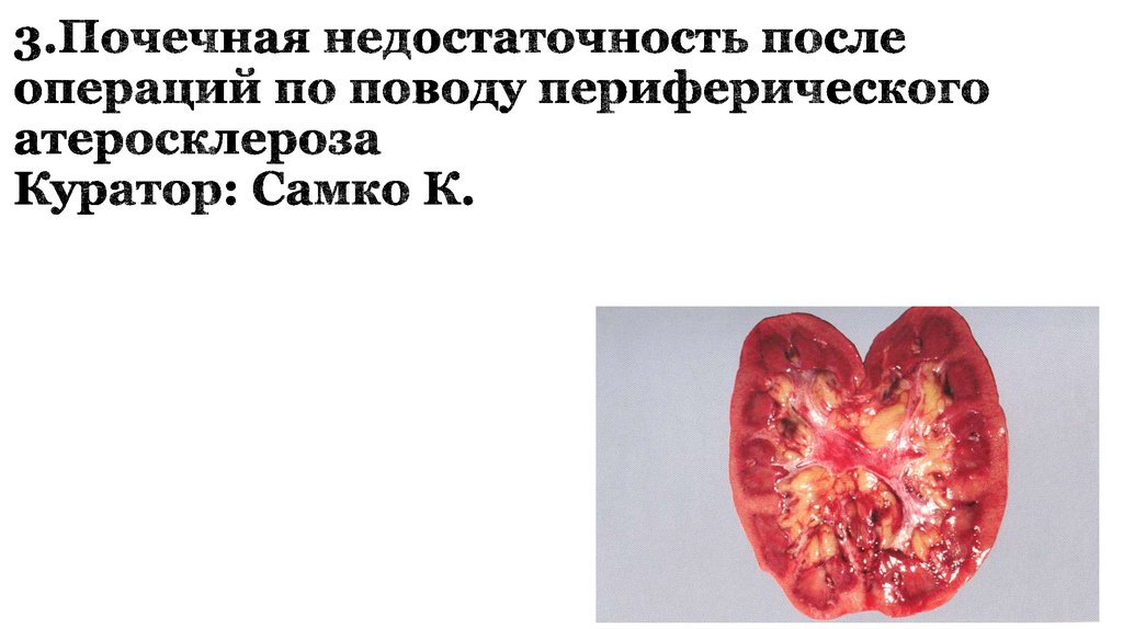 3.Почечная недостаточность после операций по поводу периферического атеросклероза Куратор: Самко К.