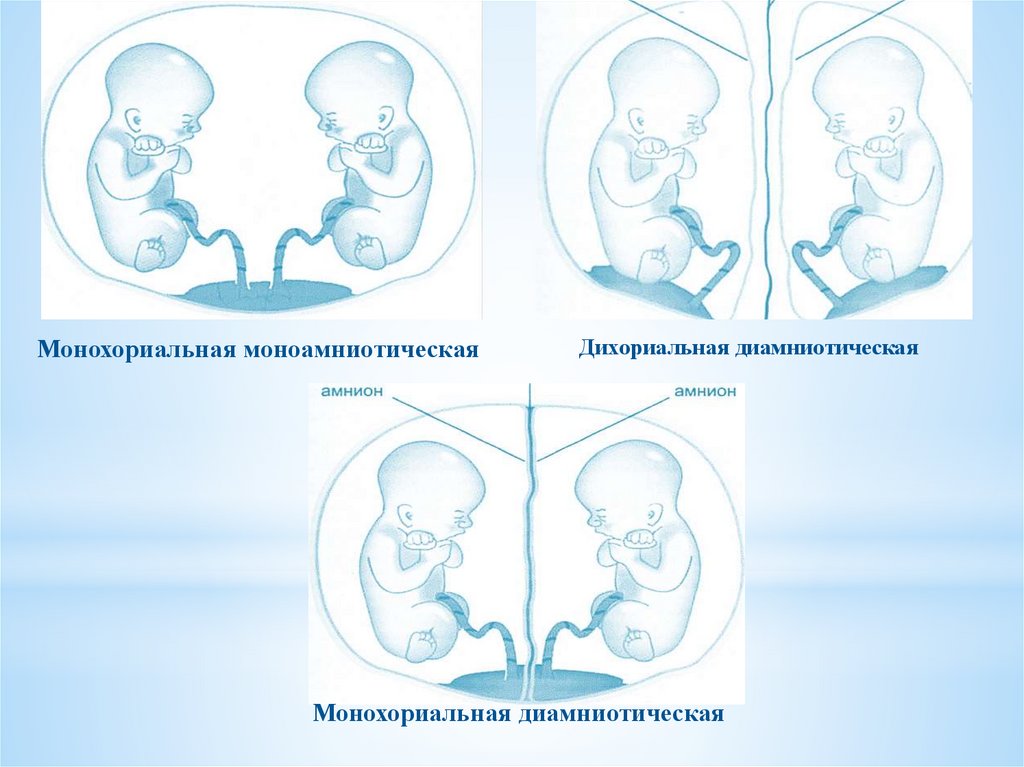 Диамниотическая двойня. Монохориальная многоплодная беременность. Монохориальная моноамниотическая многоплодная беременность. Двойняшки монохориальная диамниотическая. Монохориальная биамниотическая двойня УЗИ.