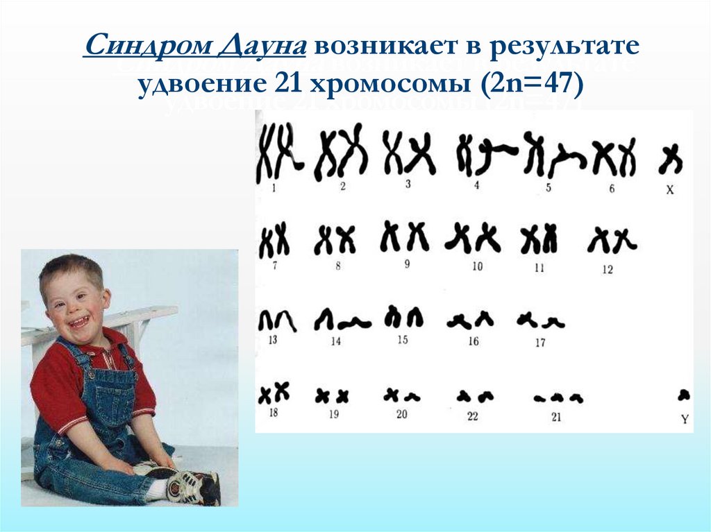 Форма изменчивости дауна. Формы изменчивости синдром Дауна. Ребенок с двумя хромосомами. Анеуплоидия. Синдром Патау картинки детей.