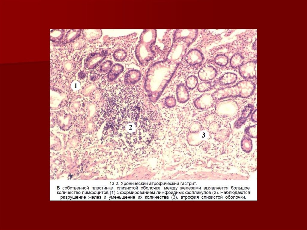 Гистологические признаки хронического гастрита. Эрозивный гастрит микропрепарат. Хронический поверхностный гастрит микропрепарат. Хронический атрофический гастрит патанатомия. Гастрит микропрепарат патанатомия.