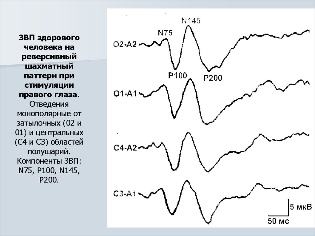 Вызванный исследования. Зрительный вызванный потенциал на шахматный паттерн. Зрительно вызванные потенциалы норма. Вызванный потенциал p600. ЗВП интерпретация результатов.