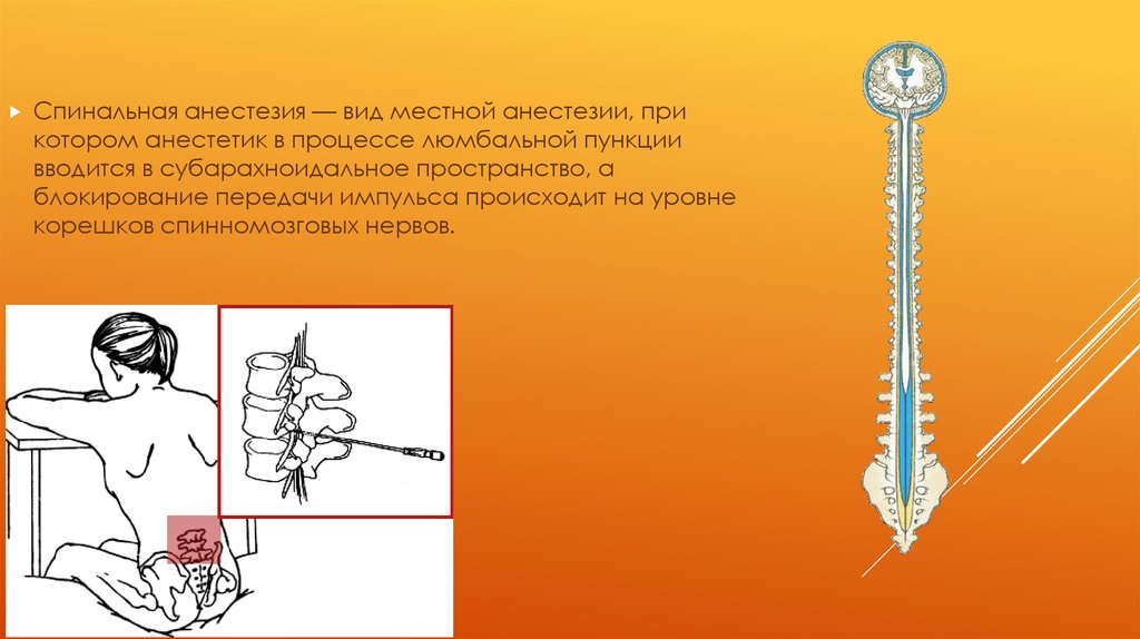 Спинномозговая анестезия. Спинномозговая анестезия уровни пункции. Спинальная местная анестезия. Уровень спинальной анестезии. Спинальная анестезия пункция.