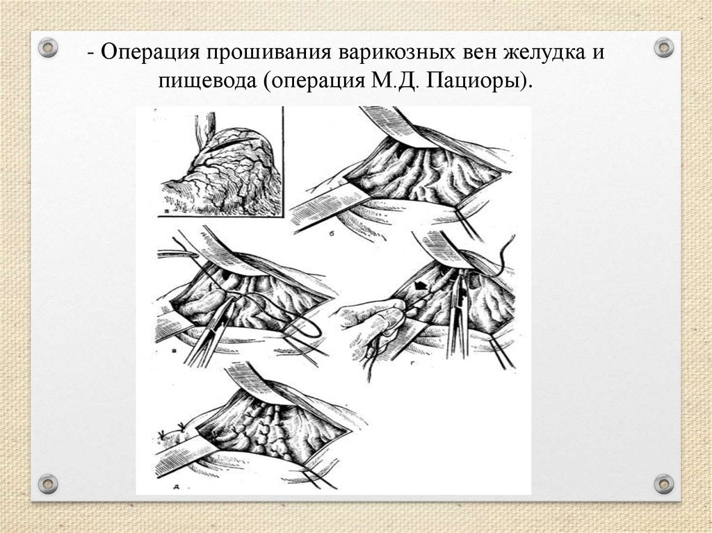 Операция м. Операция Сугиура при портальной гипертензии. Операция Пациоры техника.