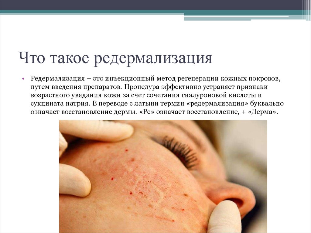 Что такое редермализация