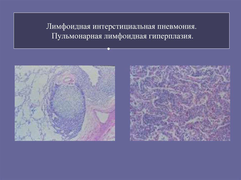 Реактивная гиперплазия лимфоузла. Лимфоидная межуточная пневмония. Гипертрофия лимфоидной ткани. Лимфофолликулярная гиперплазия гистология. Лимфоидная гиперплазия кт.