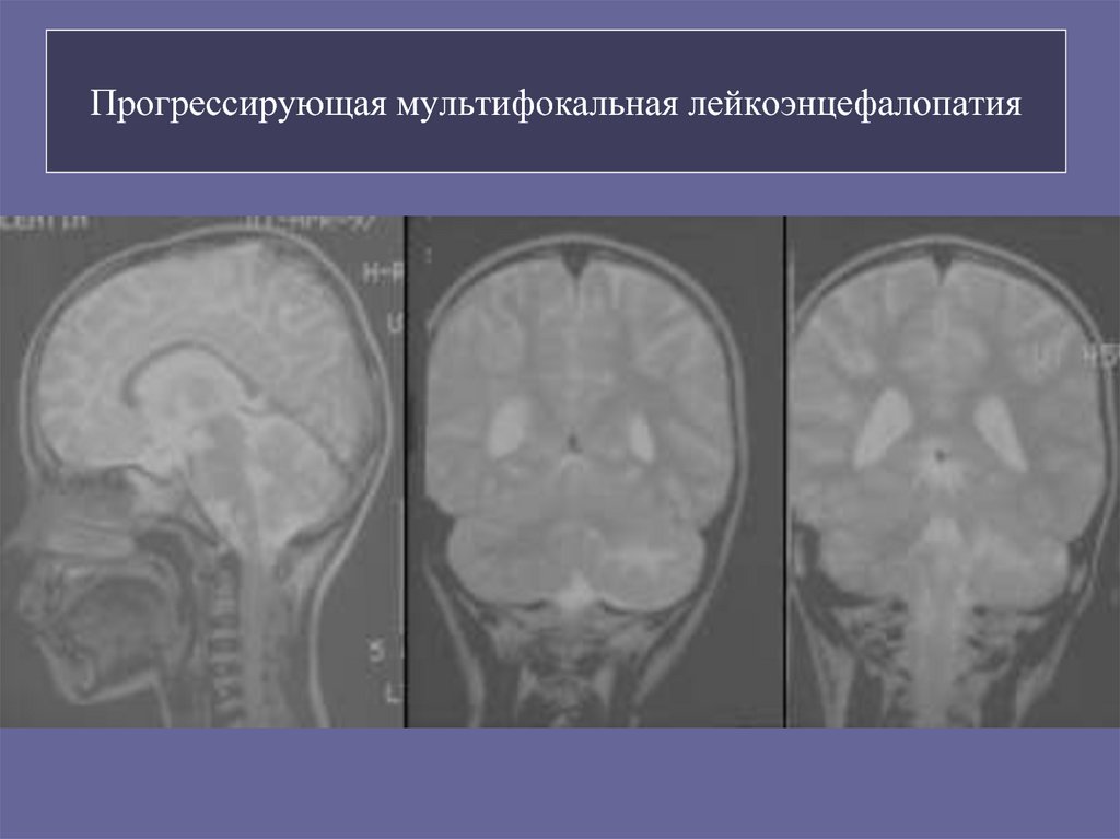 Многоочаговое поражение мозга. Прогрессирующая мультифокальная лейкоэнцефалопатия кт. ПМЛ мрт прогрессирующая мультифокальная лейкоэнцефалопатия. Мелкоочаговая лейкоэнцефалопатия. Мультифокальная лейкоэнцефалопатия головного мозга.