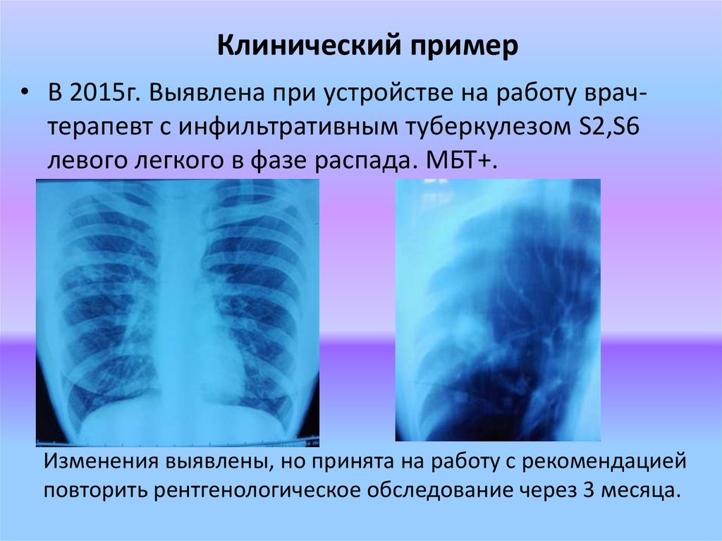 Инфильтративный легкого в фазе распада. Инфильтративный туберкулез левого легкого обсеменение. Инфильтративный туберкулез легких с1 с2 с 6. Инфильтративный туберкулез легких s2. Инфильтративный туберкулез s6.