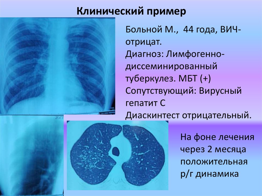 Туберкулез у взрослых. Положительная динамика туберкулеза. Гепатит, туберкулез, ВИЧ.