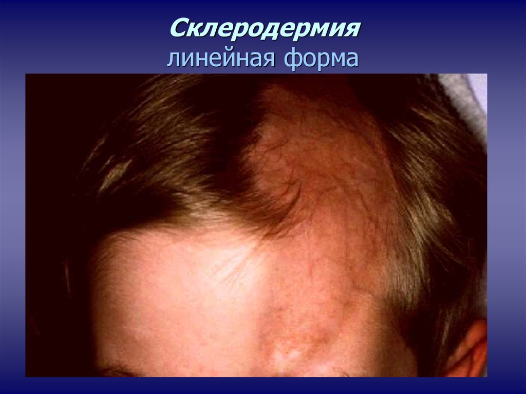 Системные заболевания кожи: склеродермия, дерматомиозит, склерема и .
