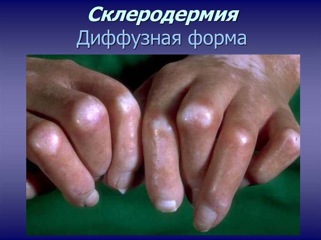 Системные заболевания кожи: склеродермия, дерматомиозит, склерема и .