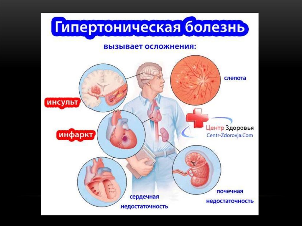 Осложнения аг. Гипертоническая болезнь органы мишени. Органы мишени артериальной гипертонии. Органы мишени при гипертонической гипертонией. Гипертоническая болезнь поражение органов мишеней.