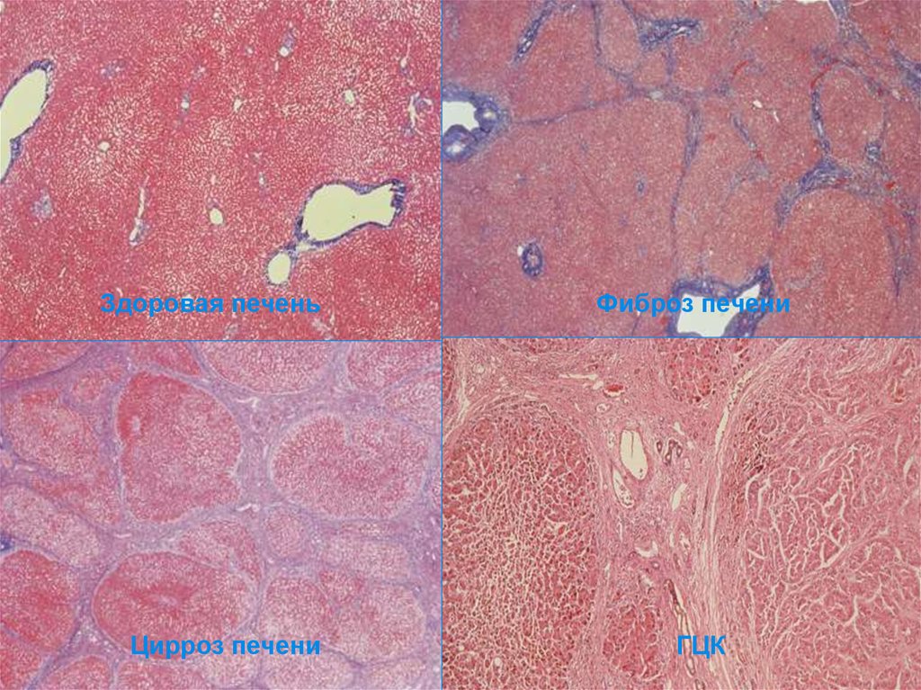 Фиброз тканей. Аутоиммунный гепатит гистология. Морфология хронического гепатита. Хронический гепатит в обострении гистология.