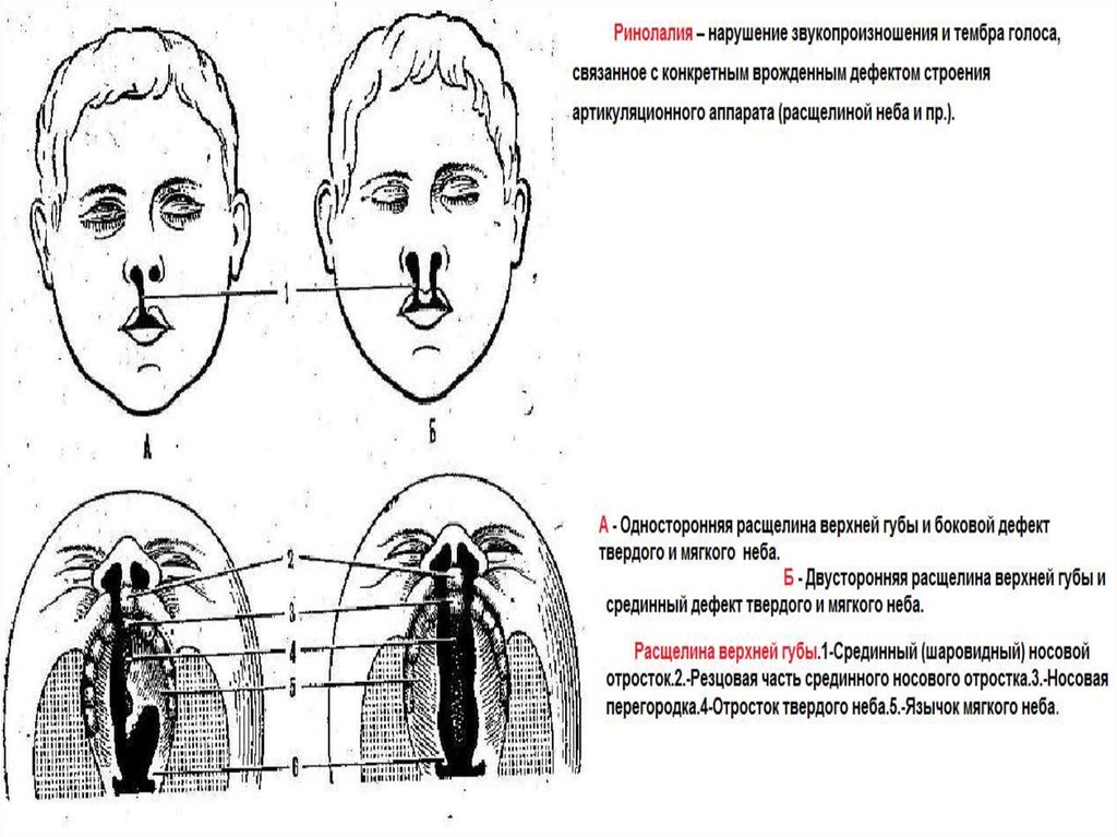 Виды расщелин губы и неба при ринолалии схема