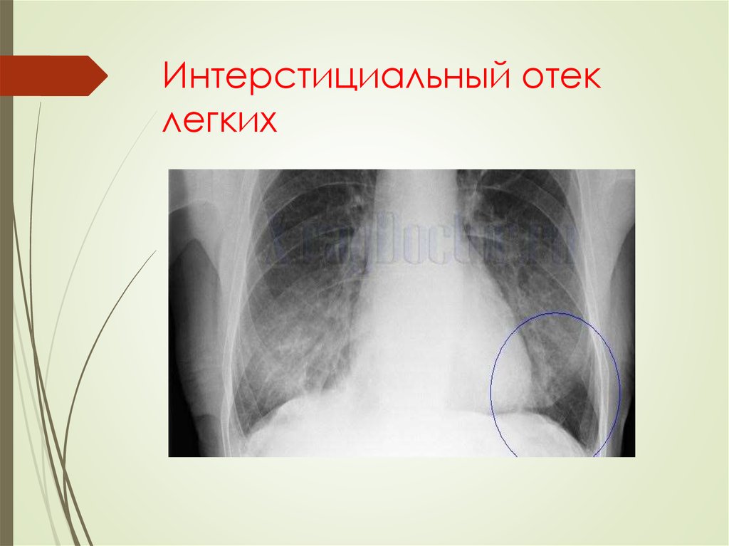 Интерстициальный легких. Интерстициальный отек легких. Интерстициальный отёк лёгких рентген. Интерстициальный отек легких рентген. Рентгенологическая картина отека легких.