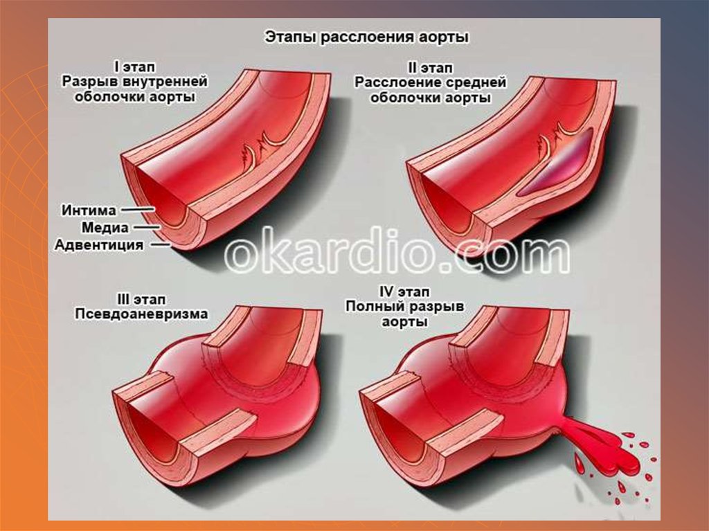 От чего бывает разрыв аорты. Разрыв аневризмы аорты причины. Аневризма аорты расслаивающая разорванная что такое.