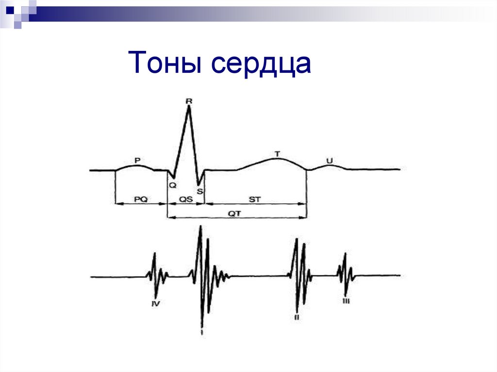 Графическое изображение тонов сердца