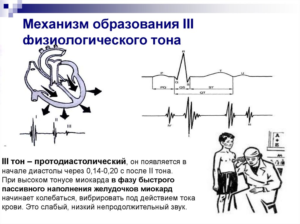 Механизм образования. Механизм образования 3 и 4 тонов сердца. Механизм образования 3 тона сердца. Механизм образования III И IV тонов сердца. Механизм возникновения III тона сердца.