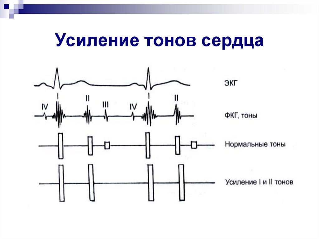 1 тон сердца. ФКГ при ослаблении 1 тона. Схема ослабления 1 тона. Усиление тонов сердца в норме и при патологии. Схема ФКГ первого тона.