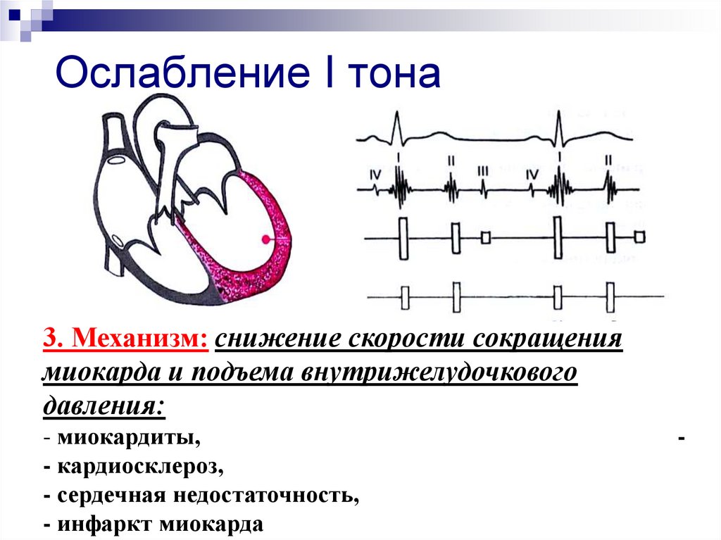 1 тон сердца. ФКГ ослабление 1 тона. Усиление и ослабление 1 тона сердца. Ослабление 1 тона на верхушке сердца. Ослабление первого тона на верхушке.