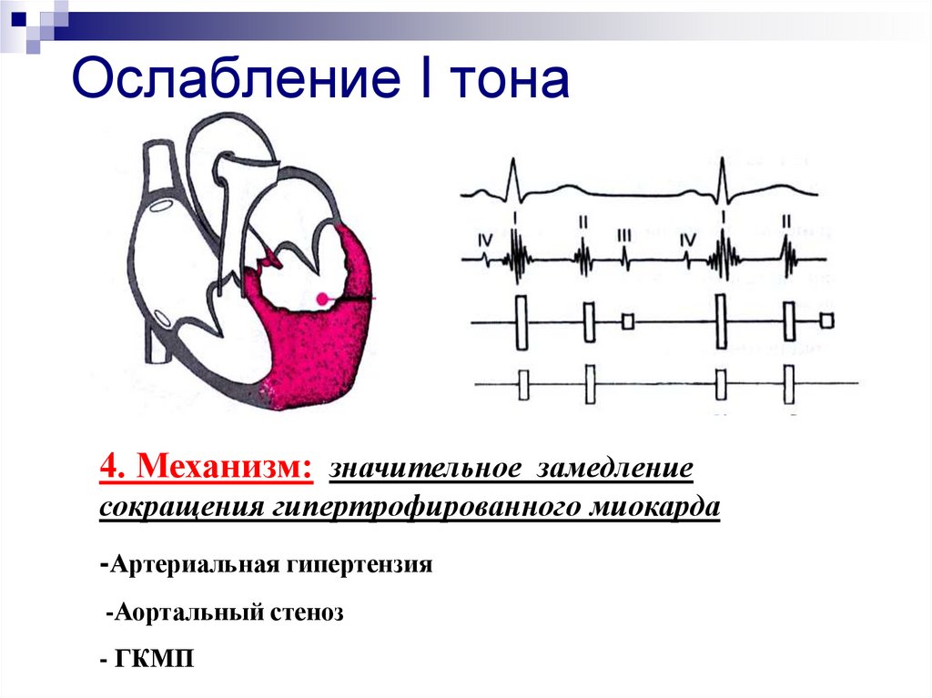 1 тон сердца. Ослабление тонов сердца в норме и при патологии. Схема усиления 1 тона. Усиление и ослабление 1 тона. Ослабление первого тона на верхушке.