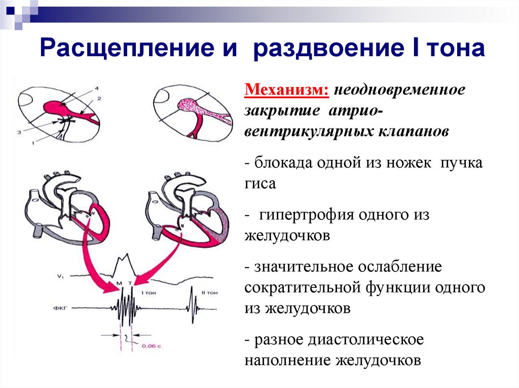 Графическое изображение тонов сердца