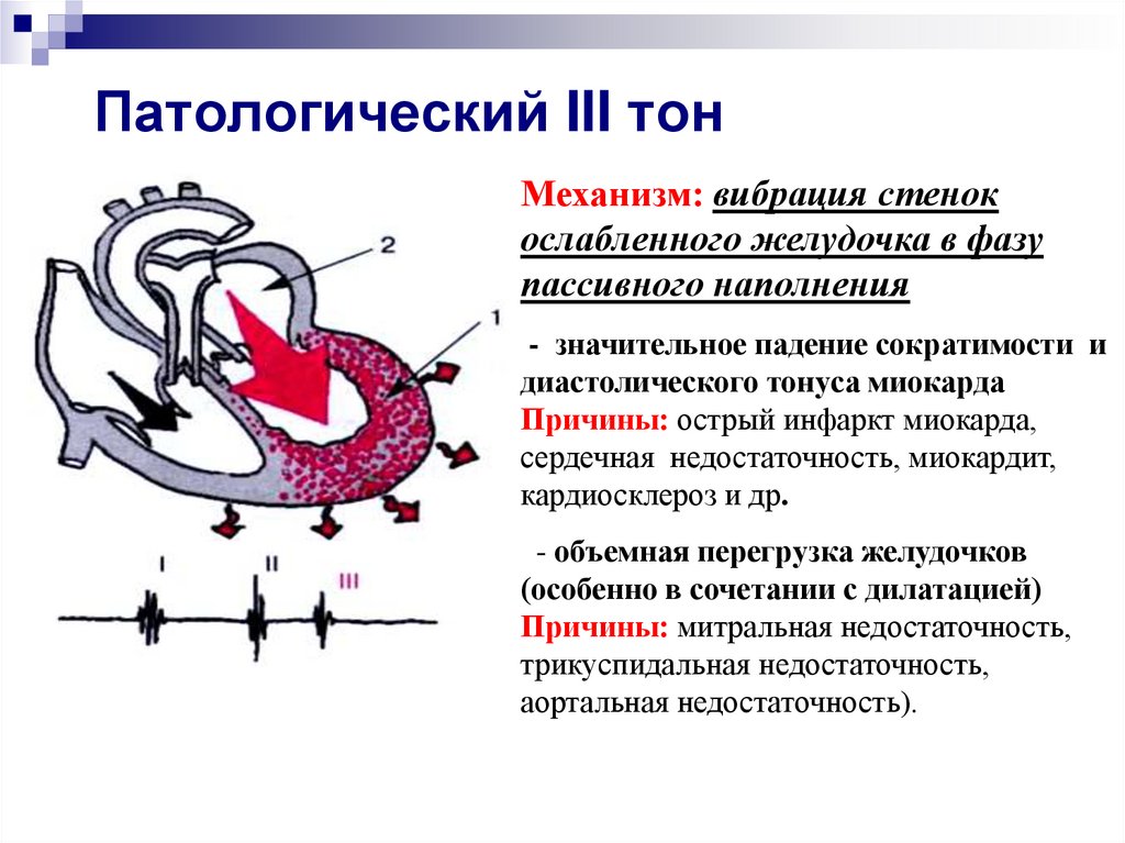 Сердечный появиться. Механизм образования 3 тона сердца. Механизм возникновения 3 тона сердца. Причины возникновения 3 тона сердца. Механизм образования 3 и 4 тонов сердца.