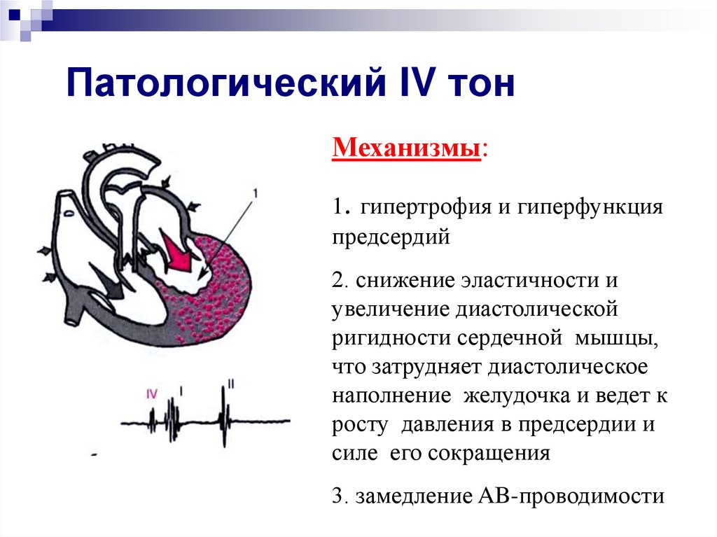 Б тон. Механизм образования тонов сердца в норме. 3 И 4 тоны сердца. Патологические 3 и 4 тоны сердца. Механизм образования 3 и 4 тонов сердца.