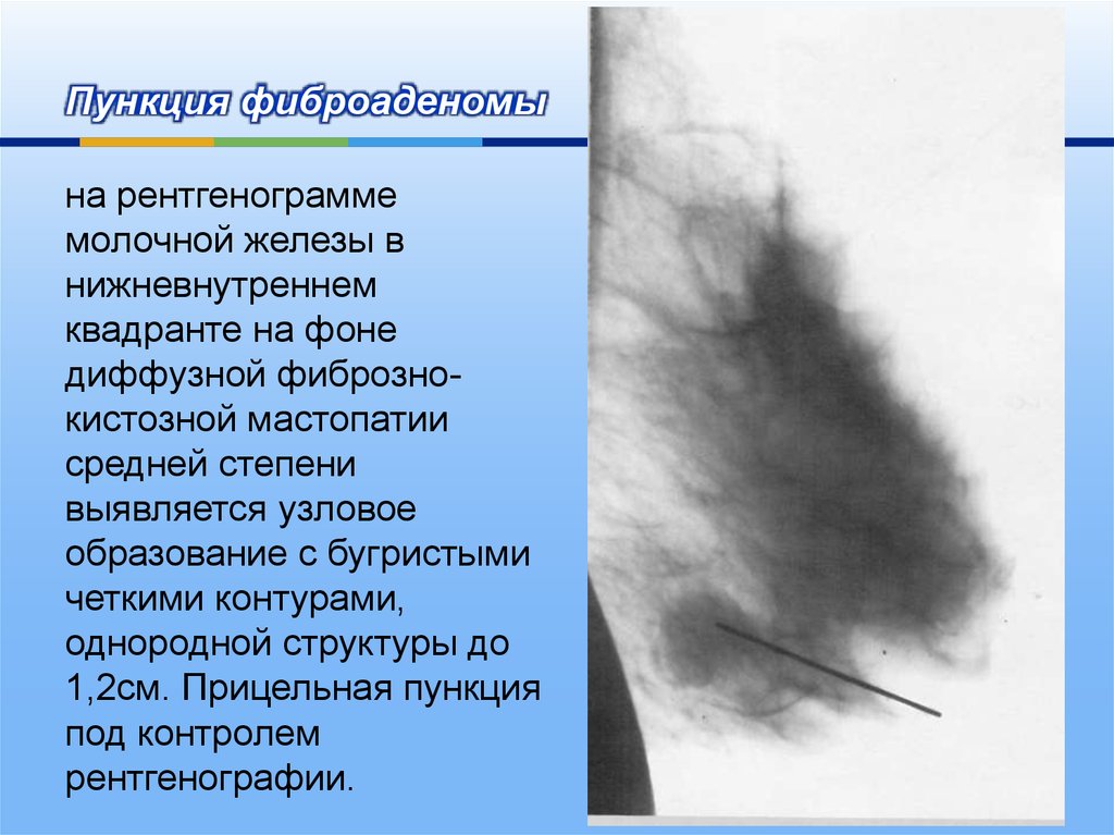 Что такое фиброаденоз молочной железы. Мастопатия молочной железы рентгенограмма. Диффузионная фиброзно-кистозная мастопатия. Фиброаденома молочной железы 1б. Мастопатия молочной железы маммограмма.