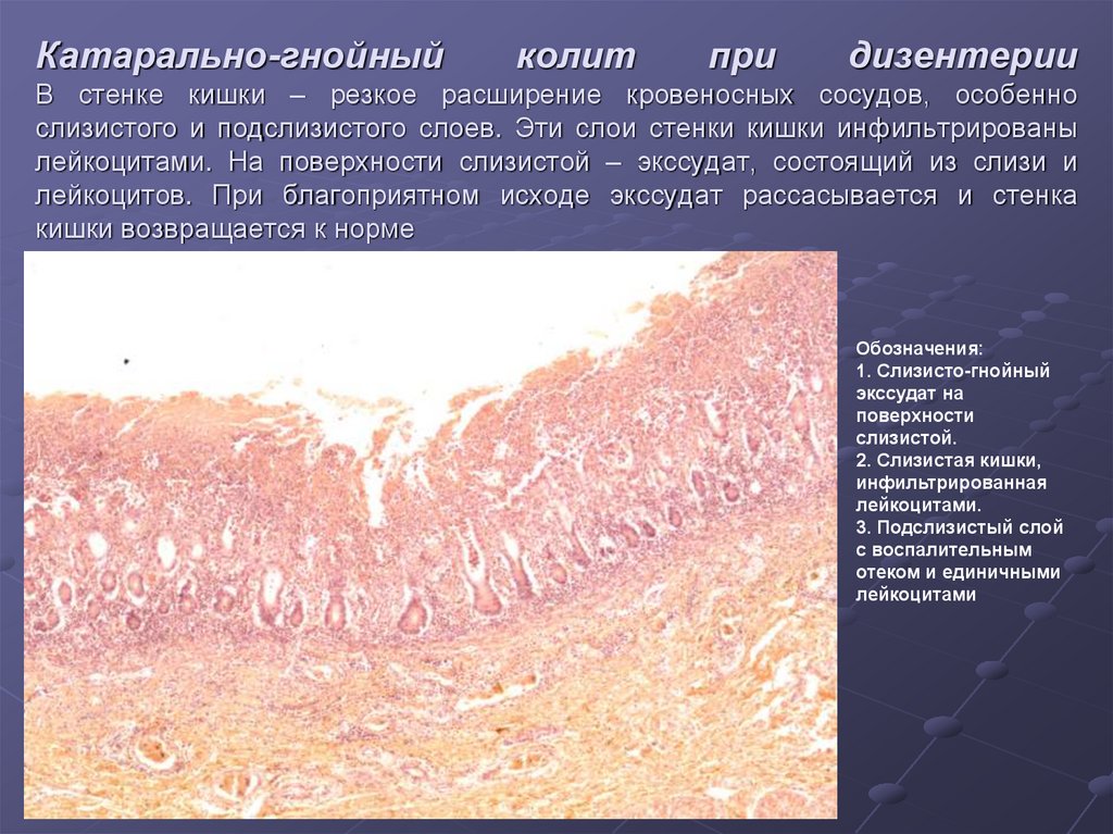 Катаральное лечение. Катаральный колит гистология. Катаральное воспаление кишечника. Катаральный колит микропрепарат.